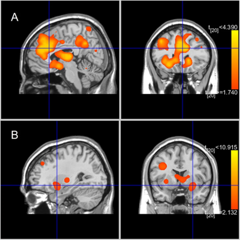 Four-panel fMRI-style brain image with statistical activation overlays. The top row (labeled “A”) shows two views of the brain (sagittal and coronal) with multiple orange clusters. The bottom row (labeled “B”) shows two corresponding views with fewer, smaller orange clusters. Blue crosshairs mark a coordinate in each panel. A vertical color bar at the right indicates intensity of the statistical map.
