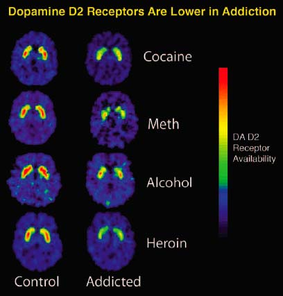 PET brain images comparing dopamine D2 receptor availability, showing lower receptor signal associated with repeated drug exposure.
