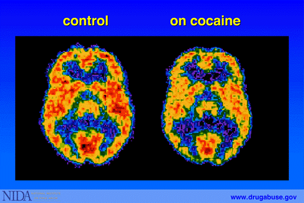Two side-by-side color brain scans labeled “control” and “on cocaine.” Warm colors indicate stronger imaging signal; the “on cocaine” scan shows a visibly different signal pattern compared with the control scan.